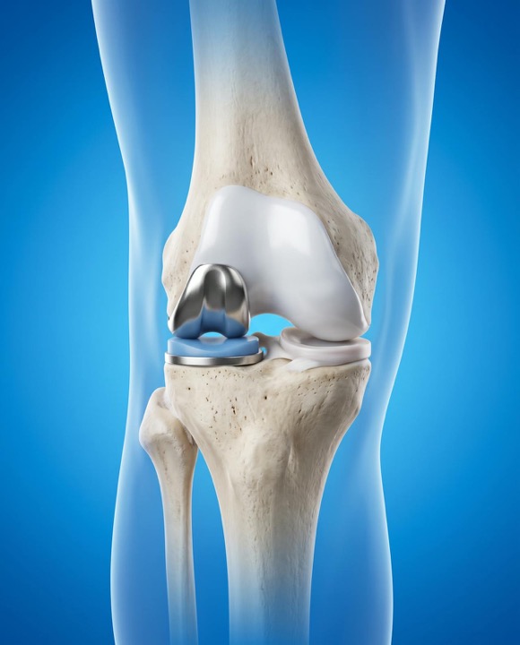 3D illustration of a partial knee replacement on one side of the knee