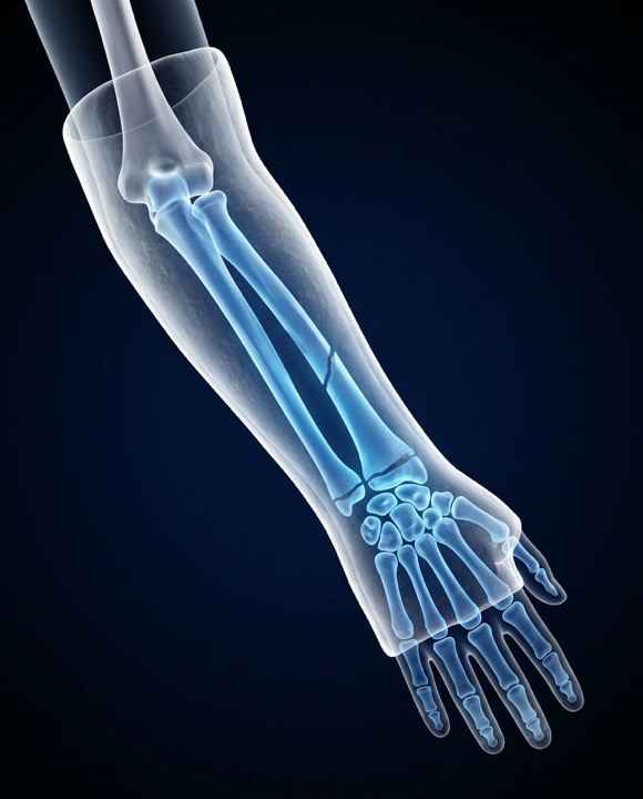 X-ray style illustration of a child's forearm fracture