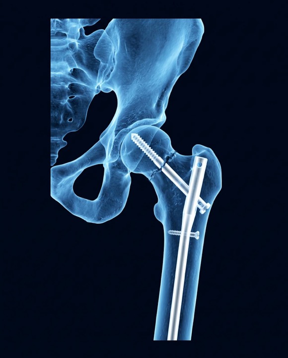 X-ray style illustration of a hip fracture fixed with a nail