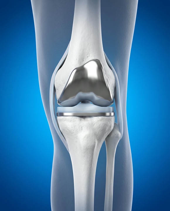 3D illustration of a total knee replacement implant