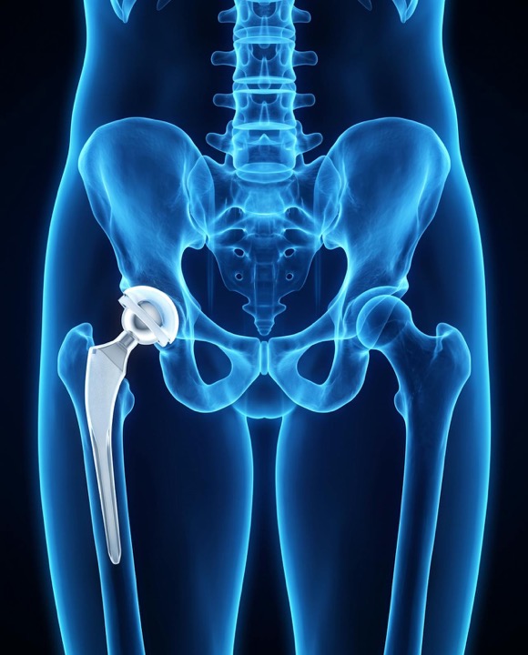 X-ray style illustration of a hip replacement implant