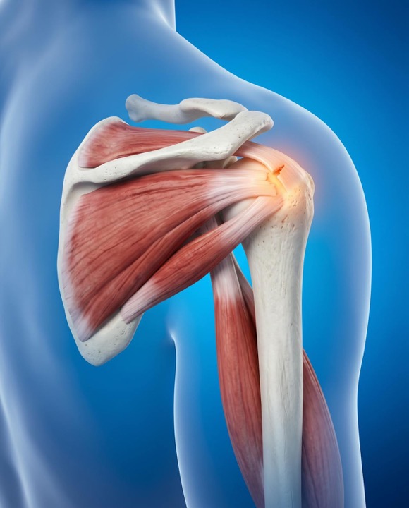 3D illustration of the shoulder rotator cuff with a torn tendon