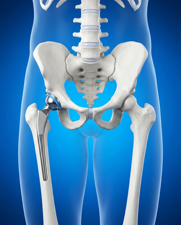 3D illustration of a total hip replacement implant