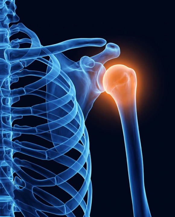 X-ray style illustration of a dislocated shoulder joint